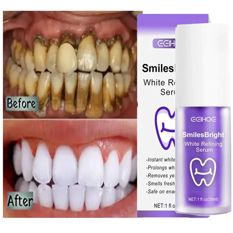 Teeth Whitening In Korea - Nettoyage des dents dentifrice blanchissant Gel