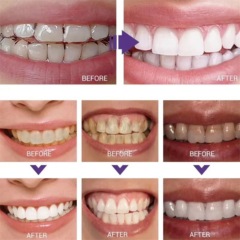 Nettoyage des dents dentifrice - Teeth Whitening In Korea avis et prix