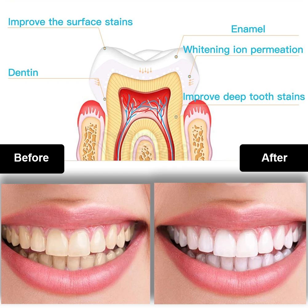 Kit de blanchiment des dents d - Teeth Whitening For Trays avis et prix